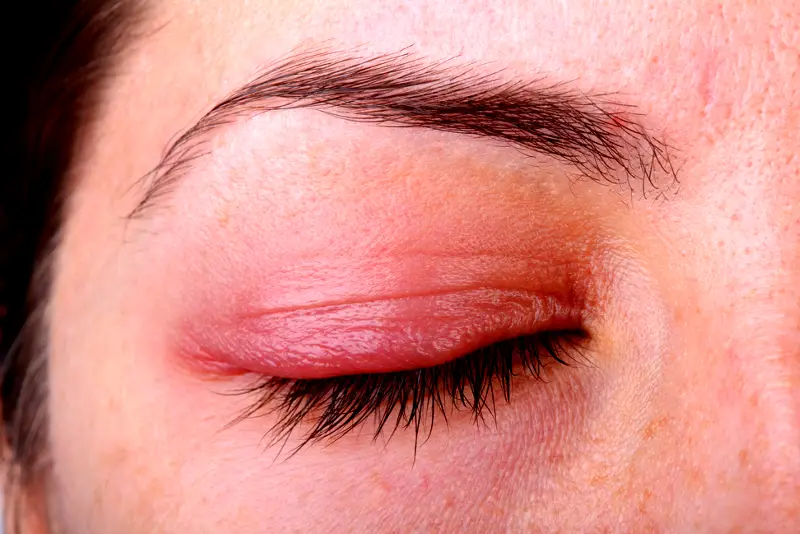 red eyelids of ocular rosacea