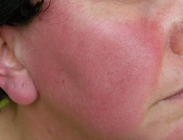 Red in the face We look at rosacea and treatments that work BLUE HARE MAGAZINE