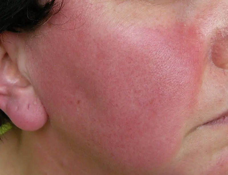 Red in the face We look at rosacea and treatments that work BLUE