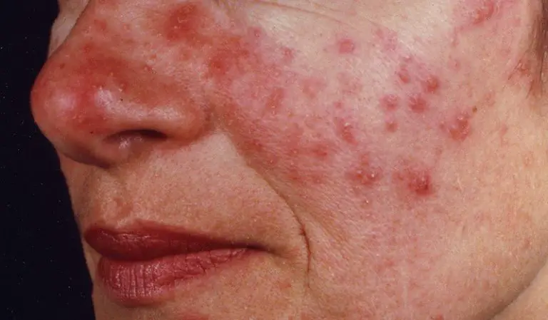 Red in the face: We look at rosacea and treatments that work | BLUE ...