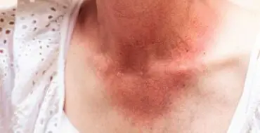 Woman over 60 with sunburn